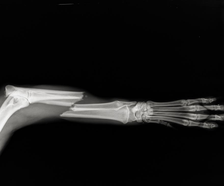 Dog leg fracture xray. Canine radius and ulna fracture radiograph
